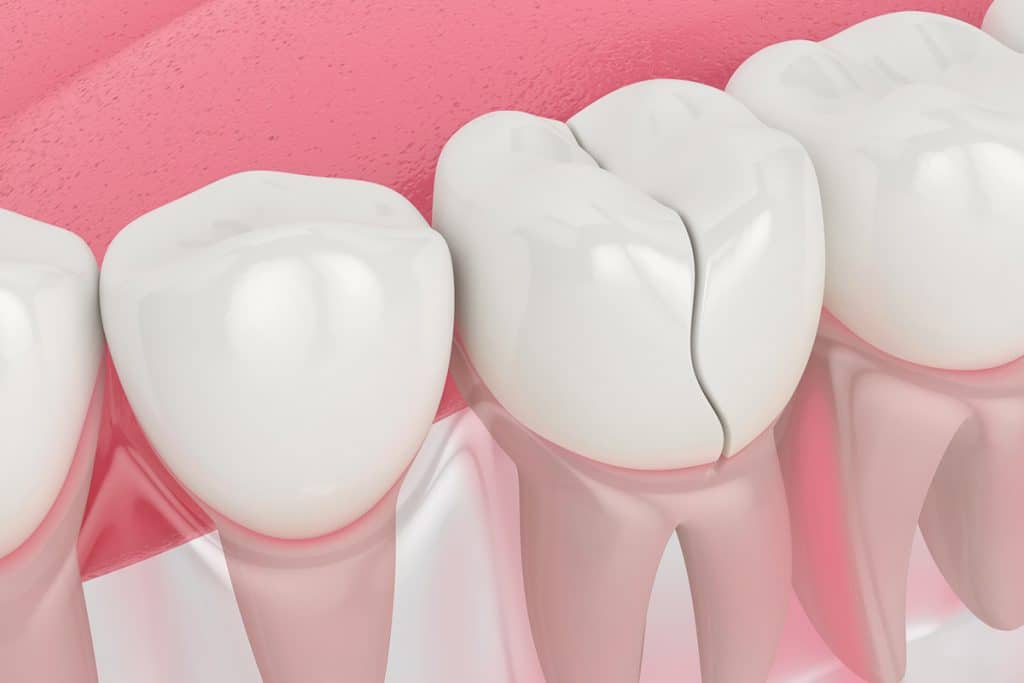 How Do You Fix A Cracked Tooth?