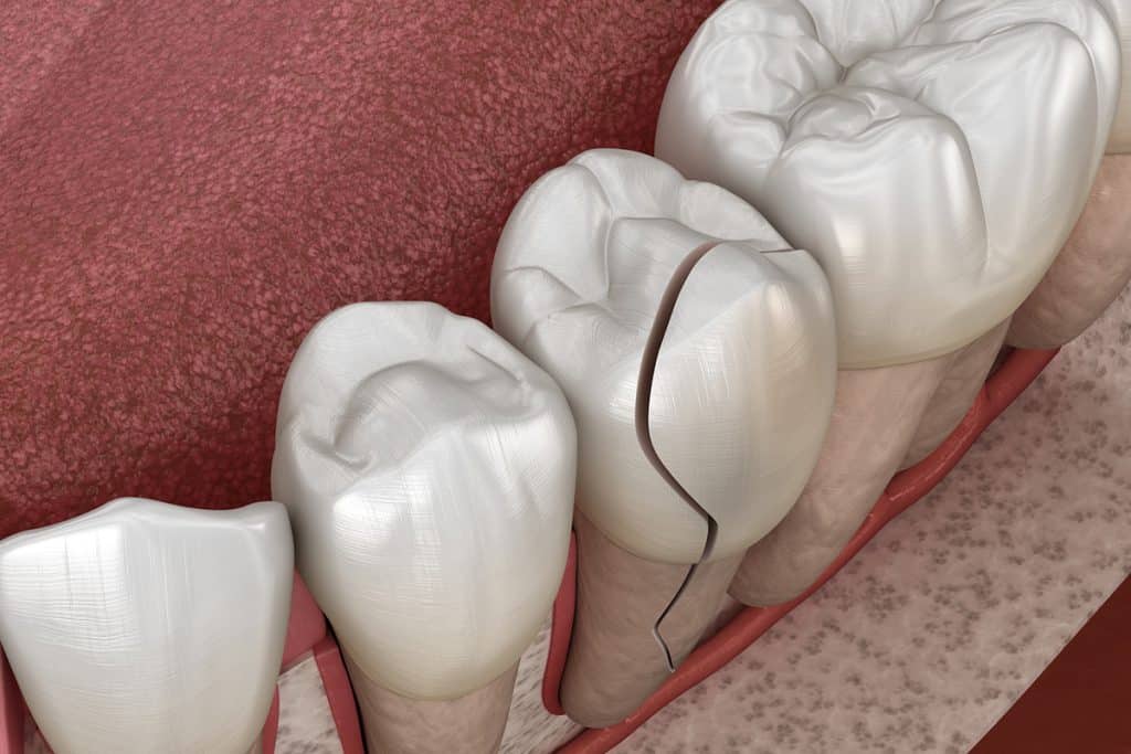 What Do You Do If Your Tooth Is Cracked Under a Crown?