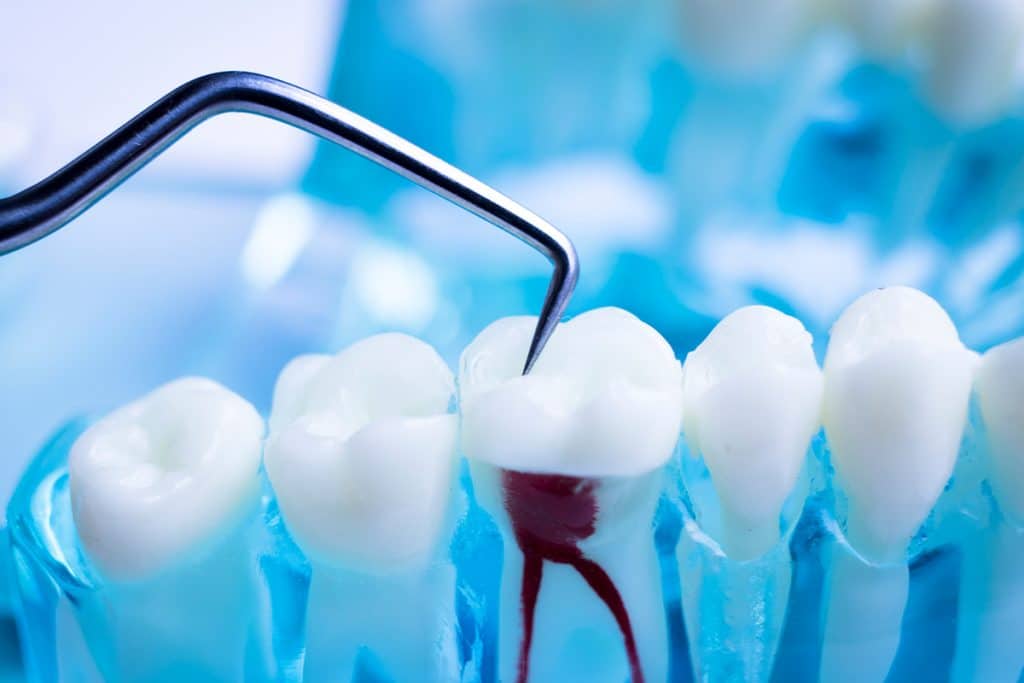 What Is The Difference Between A Root Canal & Apical Surgery?